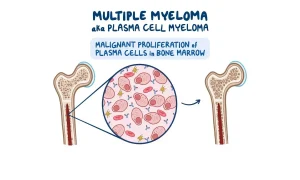 مولتیپل میلوما