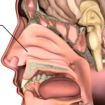 سرطان بینی چیست