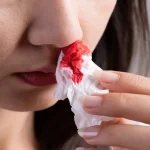 علت خون دماغ شدن از سوراخ چپ بینی